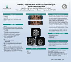 Bilateral Complete Third Nerve Palsy Secondary to Cavernous Malformation